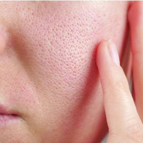 Dermo_booster > bőrpirosság és rosacea ellen