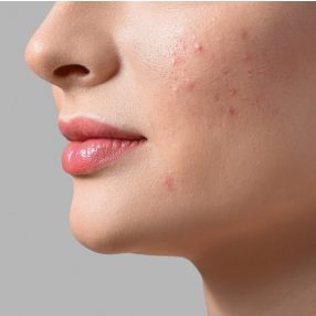 Dermo_booster > problémás bőrre, pattanások ellen